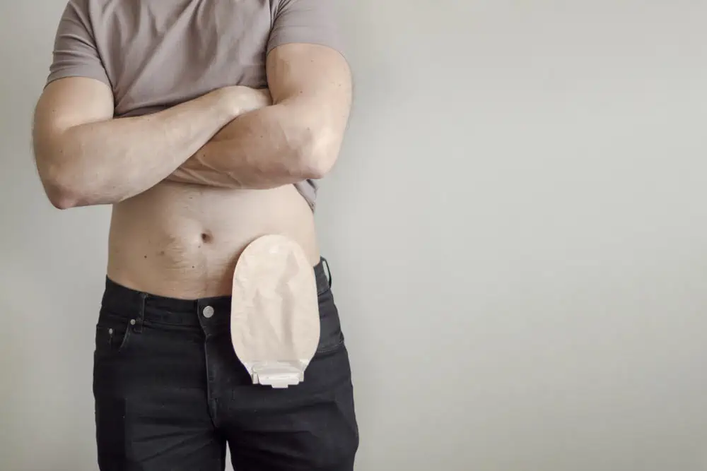 Exemple de stomie par Stomathérapeute Exemple de stomie par Stomathérapeute