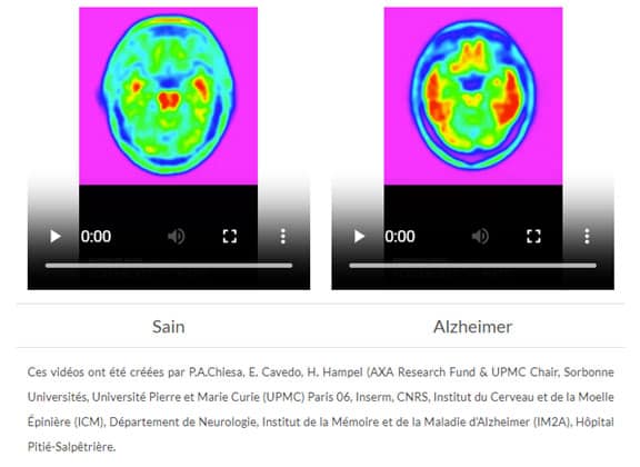 Signes maladie Alzheimer Signes maladie Alzheimer